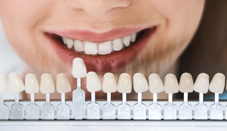 Πώς μπορούν οι οδοντικές όψεις να βελτιώσουν το χαμόγελό σας;