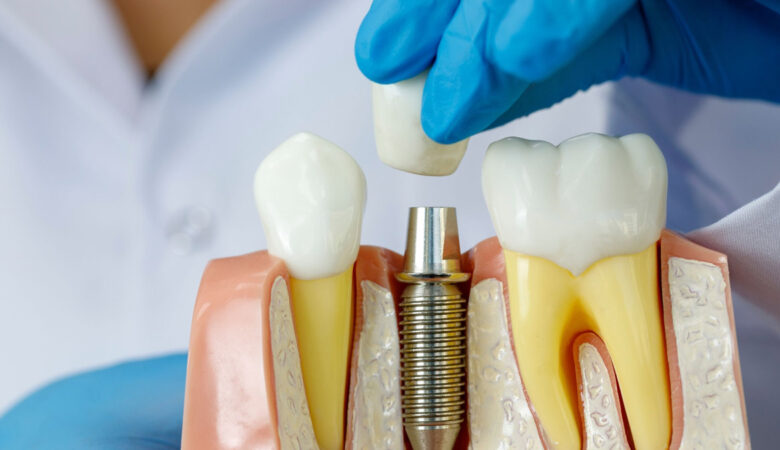 Τι να περιμένετε κατά τη διαδικασία οδοντικών εμφυτευμάτων